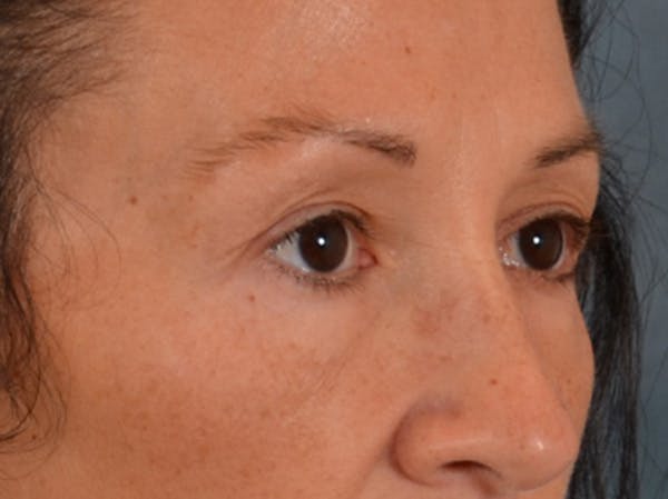 Eyelid Lift Before & After Gallery - Patient 307880 - Image 3