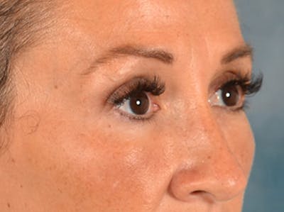 Eyelid Lift Before & After Gallery - Patient 307880 - Image 4