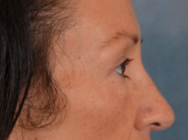 Eyelid Lift Before & After Gallery - Patient 307880 - Image 5