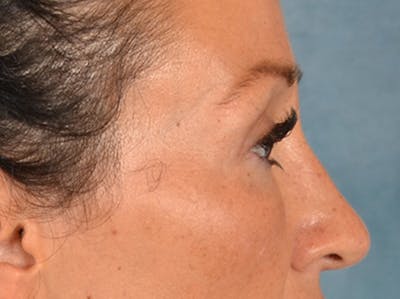 Eyelid Lift Before & After Gallery - Patient 307880 - Image 6