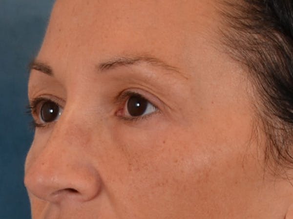 Eyelid Lift Before & After Gallery - Patient 307880 - Image 7