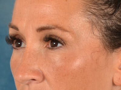 Eyelid Lift Before & After Gallery - Patient 307880 - Image 8
