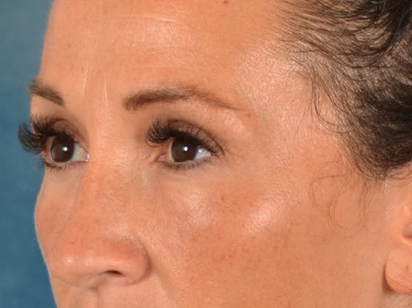 Eyelid Lift Before & After Gallery - Patient 307880 - Image 8