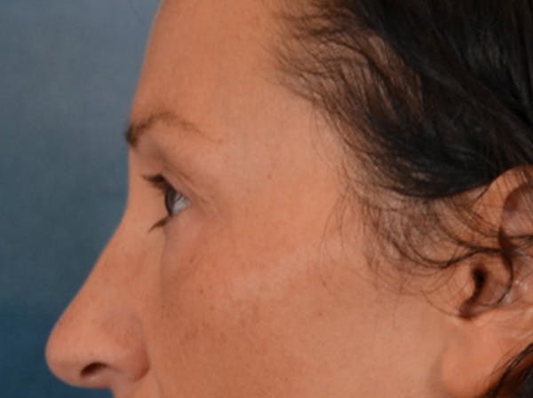 Eyelid Lift Before & After Gallery - Patient 307880 - Image 9