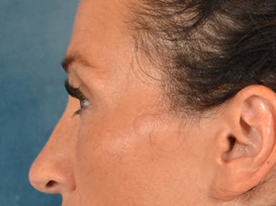 Eyelid Lift Before & After Gallery - Patient 307880 - Image 10