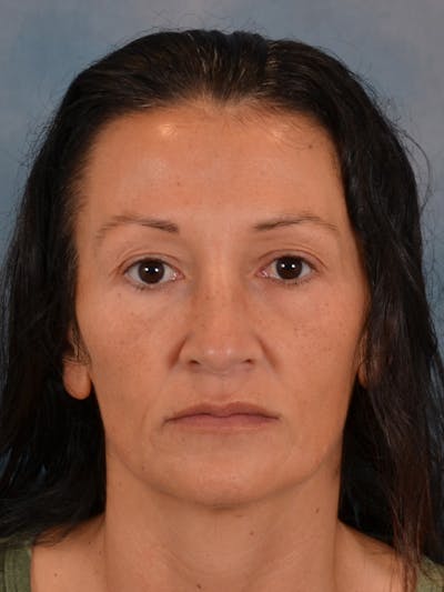 Laser Skin Resurfacing Before & After Gallery - Patient 298436 - Image 1