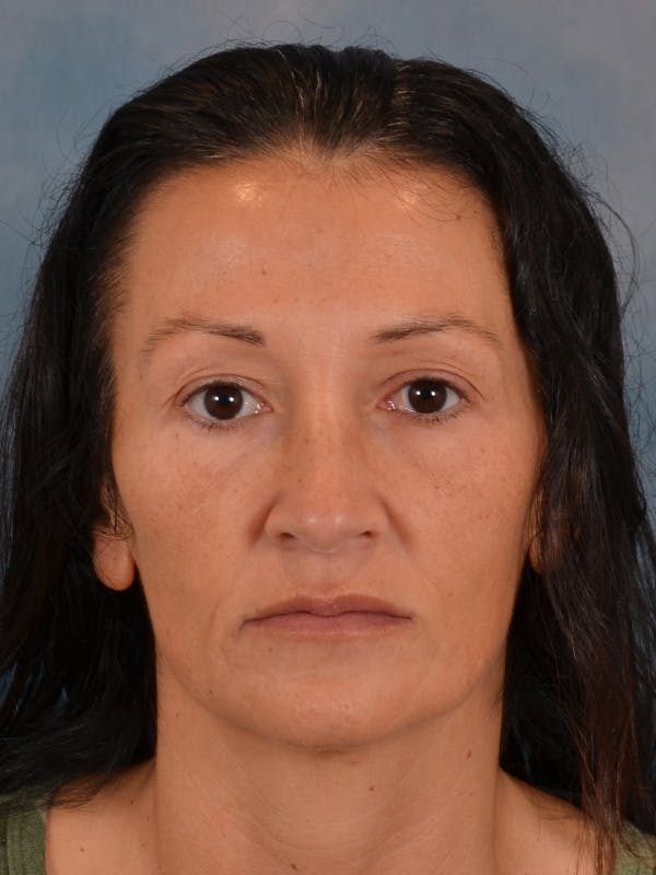 Laser Skin Resurfacing Before & After Gallery - Patient 298436 - Image 1