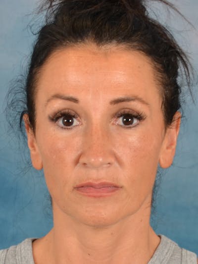 Laser Skin Resurfacing Before & After Gallery - Patient 298436 - Image 2