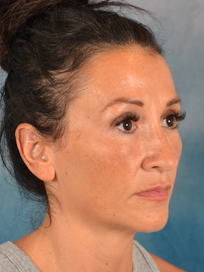 Laser Skin Resurfacing Before & After Gallery - Patient 298436 - Image 4