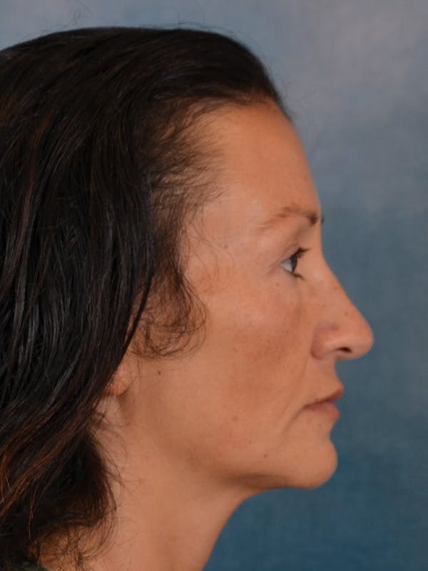 Laser Skin Resurfacing Before & After Gallery - Patient 298436 - Image 5