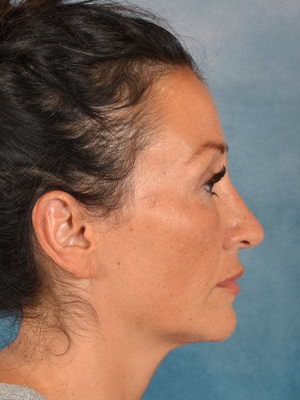 Laser Skin Resurfacing Before & After Gallery - Patient 298436 - Image 6
