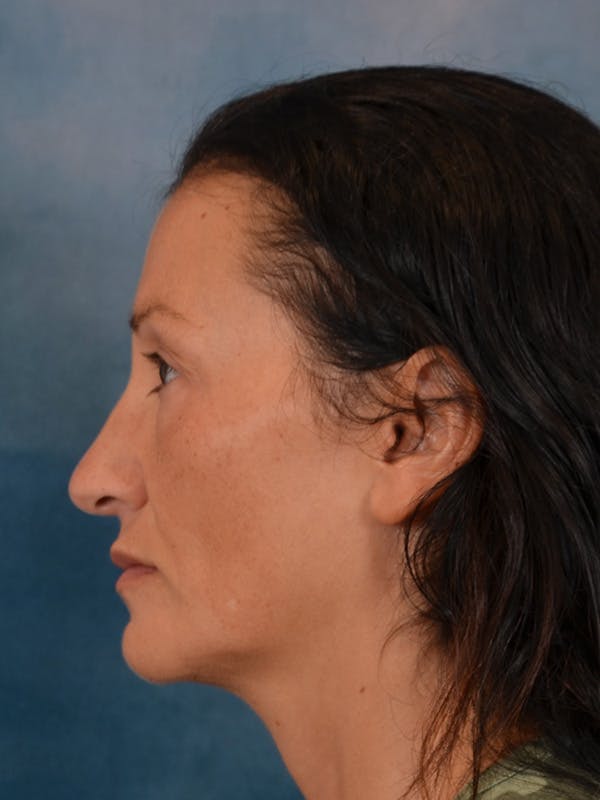Laser Skin Resurfacing Before & After Gallery - Patient 298436 - Image 9