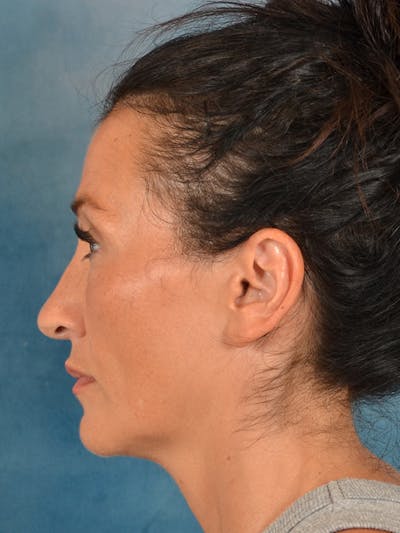 Laser Skin Resurfacing Before & After Gallery - Patient 298436 - Image 10