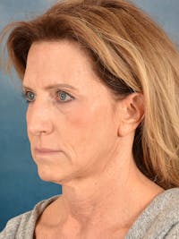 Deep Plane Facelift Before & After Gallery - Patient 184534 - Image 1