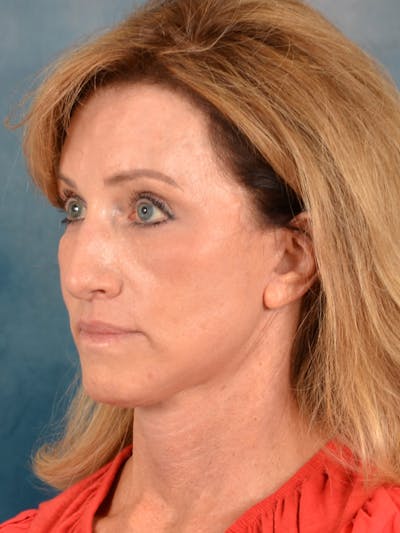 Earlobe Repair Before & After Gallery - Patient 343952 - Image 2