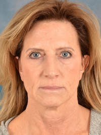 Brow Lift Before & After Gallery - Patient 325354 - Image 1