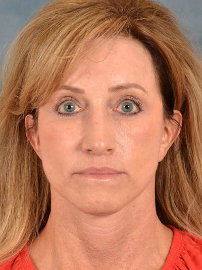 Earlobe Repair Before & After Gallery - Patient 343952 - Image 6