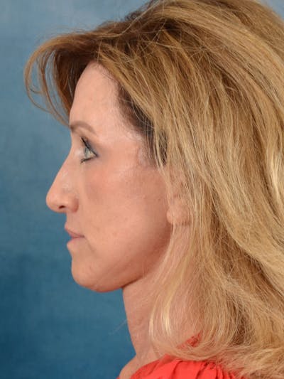 Earlobe Repair Before & After Gallery - Patient 343952 - Image 4