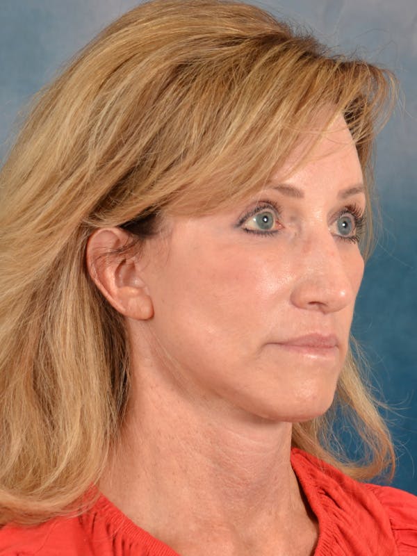 Earlobe Repair Before & After Gallery - Patient 343952 - Image 8