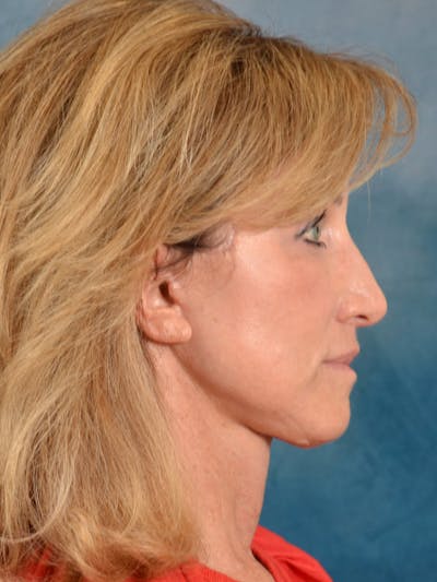 Earlobe Repair Before & After Gallery - Patient 343952 - Image 10