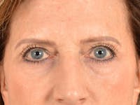 Brow Lift Before & After Gallery - Patient 294796 - Image 1