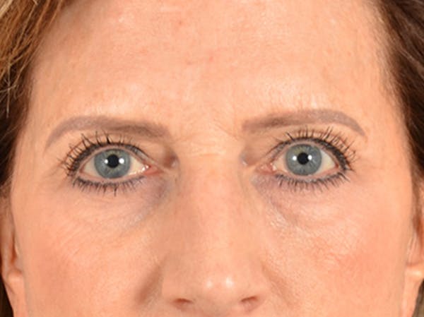 Brow Lift Before & After Gallery - Patient 294796 - Image 1