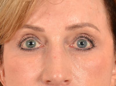 Brow Lift Before & After Gallery - Patient 294796 - Image 2