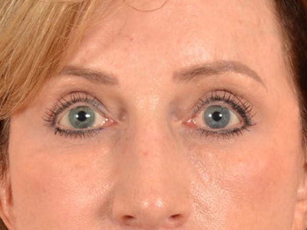 Brow Lift Before & After Gallery - Patient 294796 - Image 2