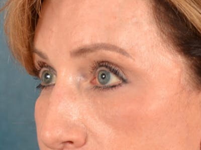 Brow Lift Before & After Gallery - Patient 294796 - Image 4