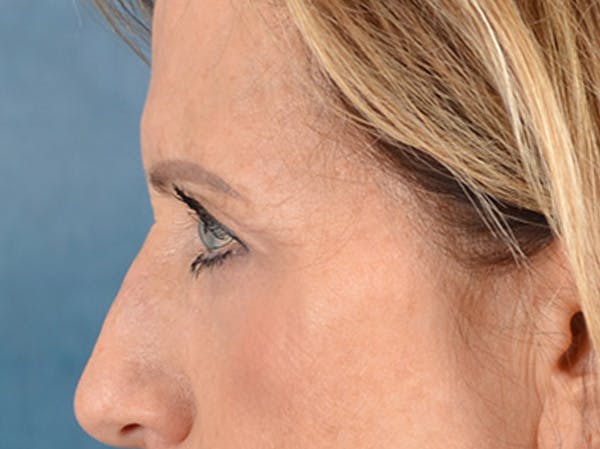 Brow Lift Before & After Gallery - Patient 294796 - Image 5