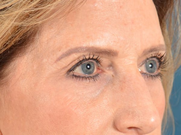 Brow Lift Before & After Gallery - Patient 294796 - Image 7