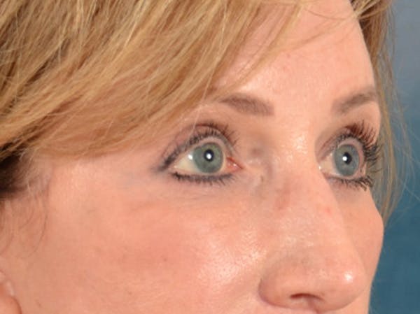 Brow Lift Before & After Gallery - Patient 294796 - Image 8