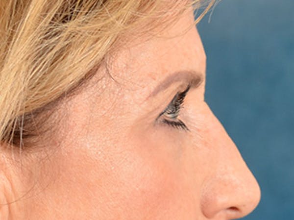 Brow Lift Before & After Gallery - Patient 294796 - Image 9