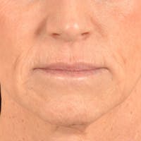 Lip Lift Before & After Gallery - Patient 267953 - Image 1