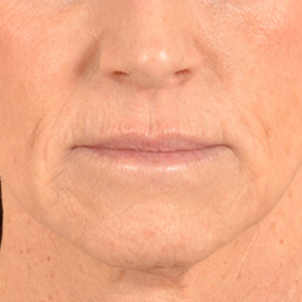 Lip Lift Before & After Gallery - Patient 267953 - Image 1