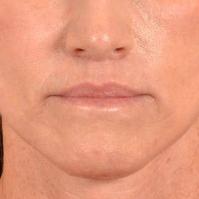 Lip Lift Before & After Gallery - Patient 267953 - Image 2