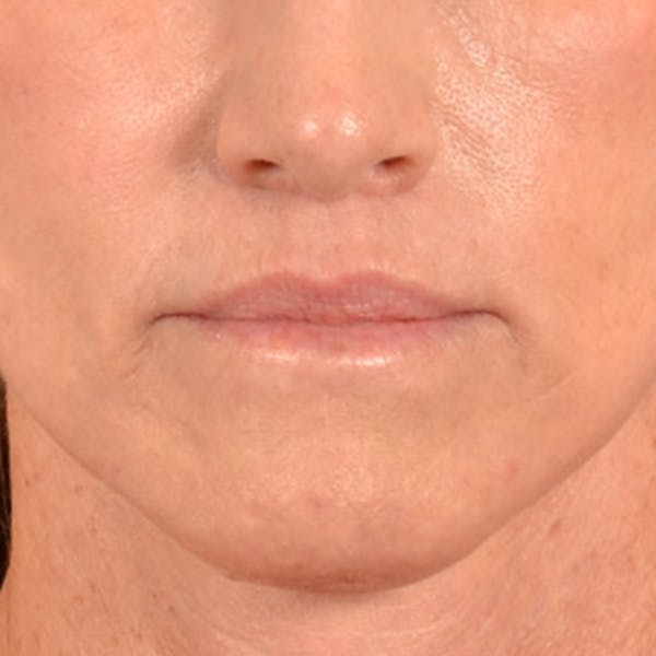 Lip Lift Before & After Gallery - Patient 267953 - Image 2