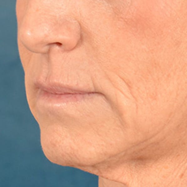 Lip Lift Before & After Gallery - Patient 267953 - Image 3
