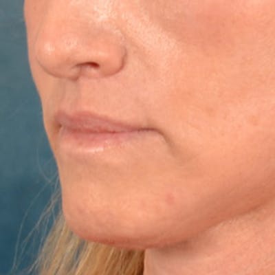 Lip Lift Before & After Gallery - Patient 267953 - Image 4