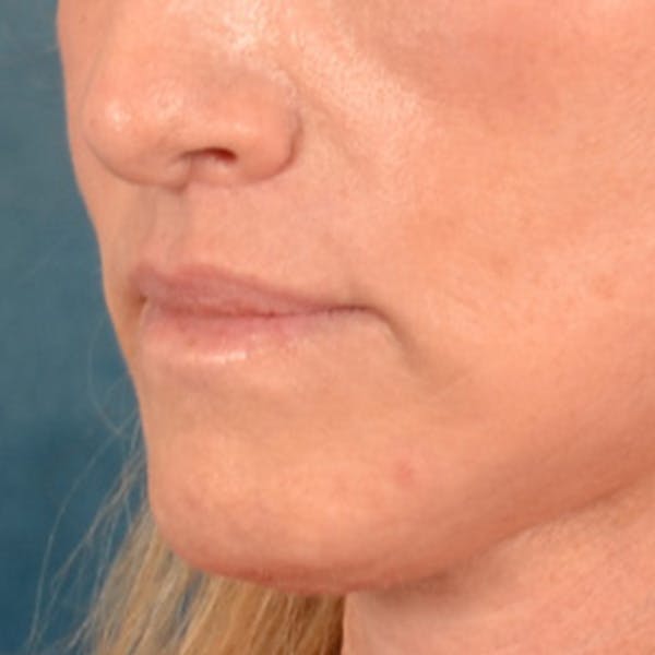 Lip Lift Before & After Gallery - Patient 267953 - Image 4