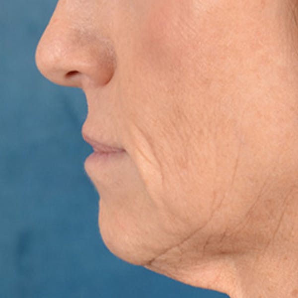 Lip Lift Before & After Gallery - Patient 267953 - Image 5