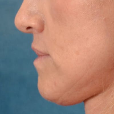 Lip Lift Before & After Gallery - Patient 267953 - Image 6