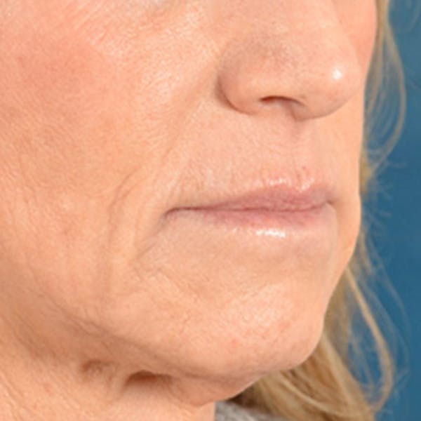 Lip Lift Before & After Gallery - Patient 267953 - Image 7
