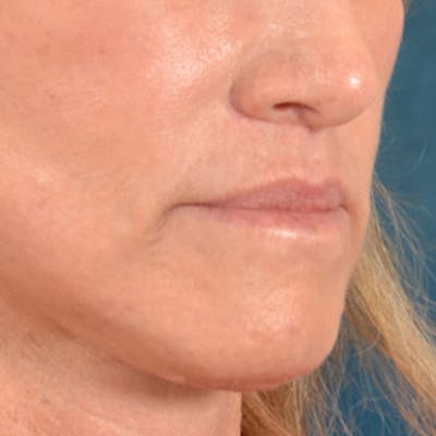 Lip Lift Before & After Gallery - Patient 267953 - Image 8