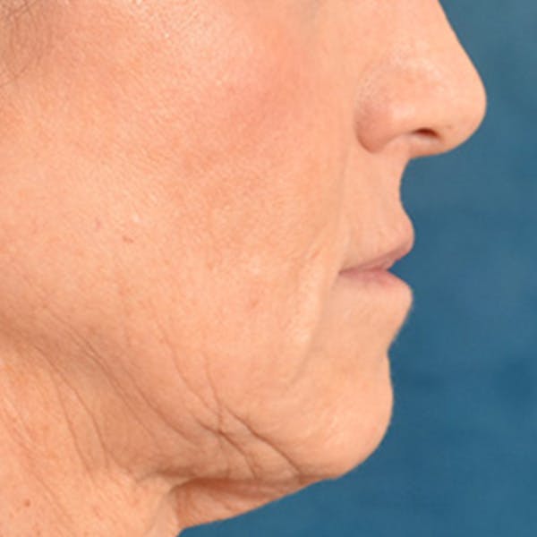 Lip Lift Before & After Gallery - Patient 267953 - Image 9