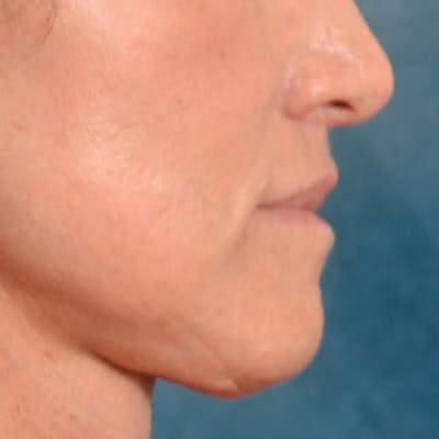 Lip Lift Before & After Gallery - Patient 267953 - Image 10