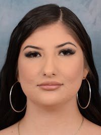Neck Liposuction Before & After Gallery - Patient 380602 - Image 1