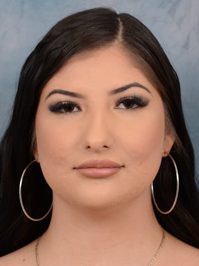 Neck Liposuction Before & After Gallery - Patient 380602 - Image 1