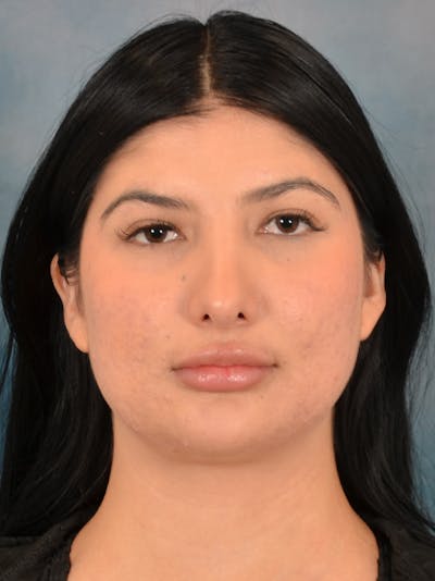 Rhinoplasty Before & After Gallery - Patient 360115 - Image 6