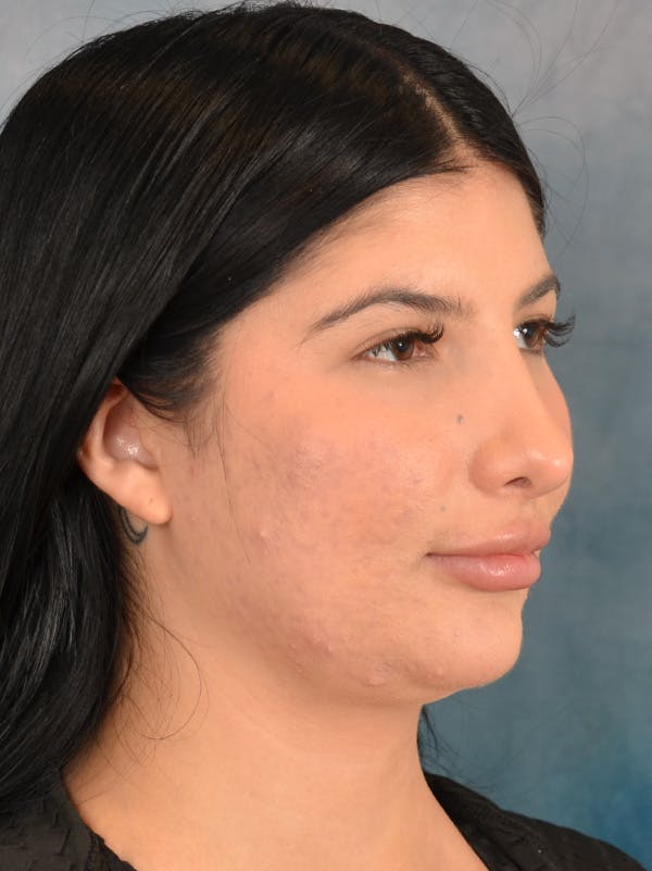 Rhinoplasty Before & After Gallery - Patient 360115 - Image 8